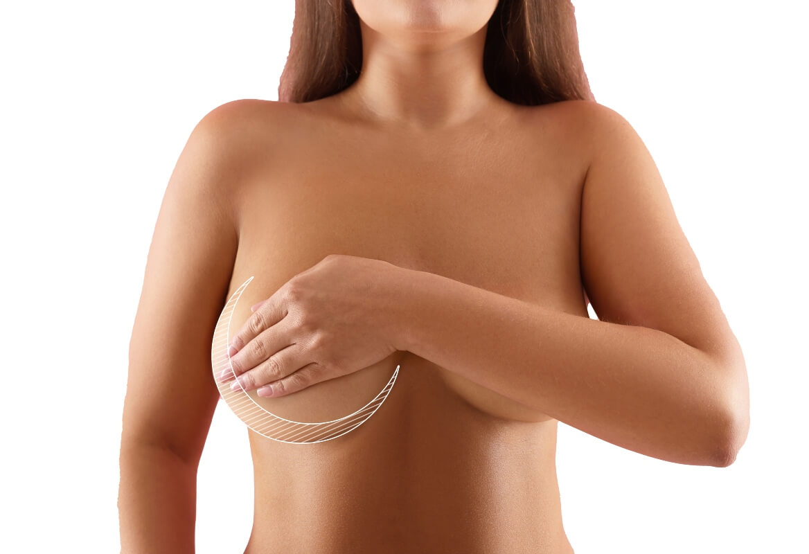 /images/procedures/breast-lift-with-implants.jpg